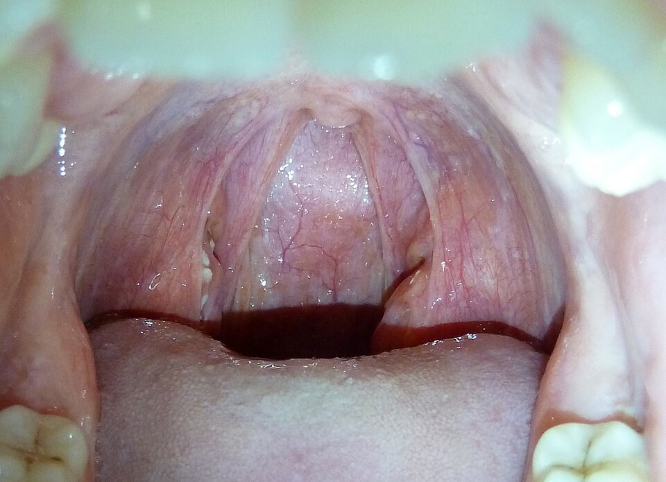 Inflamed tonsils with white spots