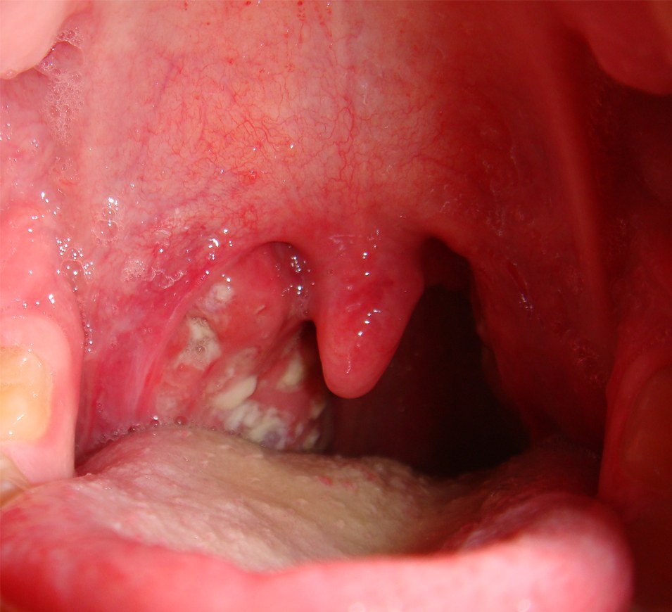 Swollen tonsils with white patches from tonsillitis
