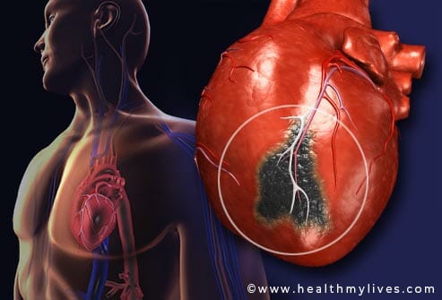 Heart attack causes and symptoms