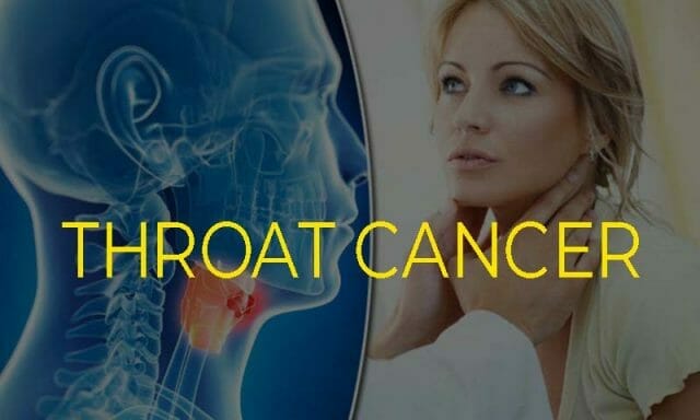 Throat cancer