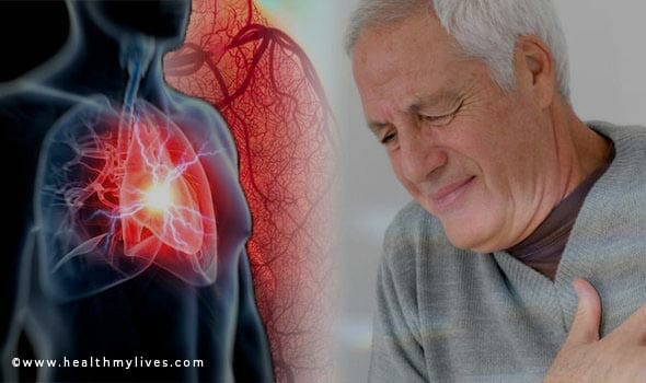 heart attack prevention