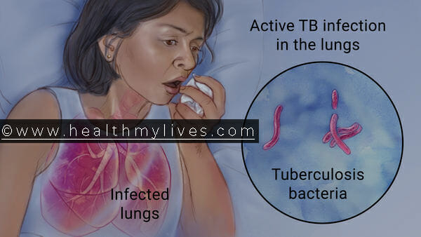 Tuberculosis Causes