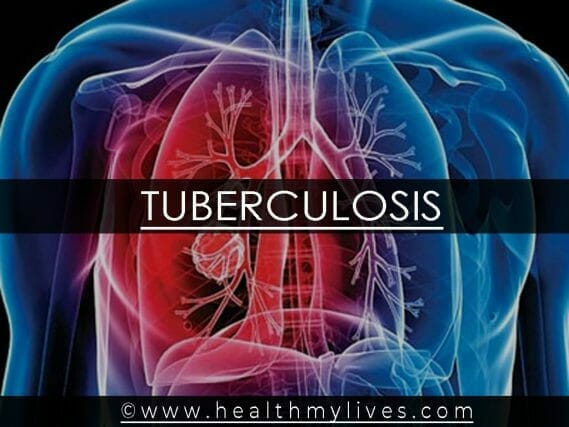 Tuberculosis treatments
