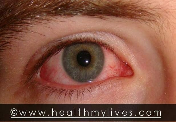 Red eyes gonorrhea