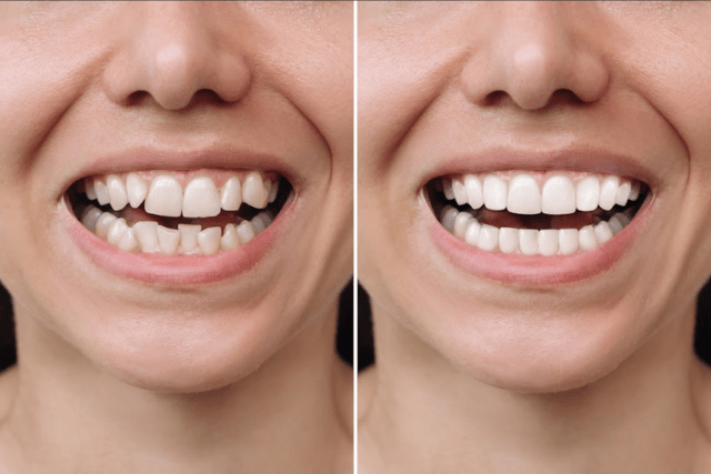 set of teeth before and after dental procedure